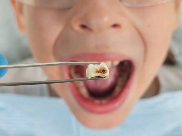 Best Emergency Tooth Extraction in Canaan, CT